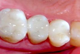 dental filling