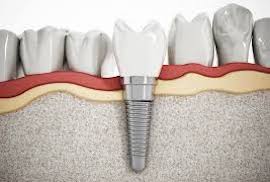 Dental implant